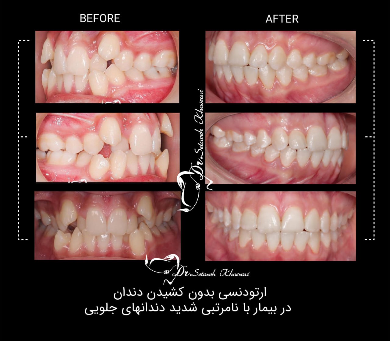 ارتودنسی بدون کشیدن دندان با نامرتبی شدید دندانها