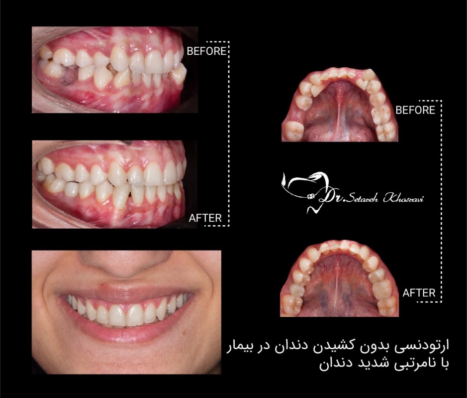 ارتودنسی بدون کشیدن دندان