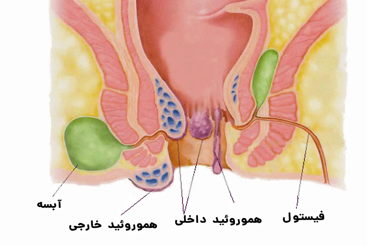 خطر ایجاد بیماری‌های همزمان (شقاق و فیستول)