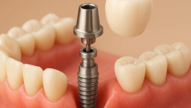 بهترین متخصص ایمپلنت در رشت