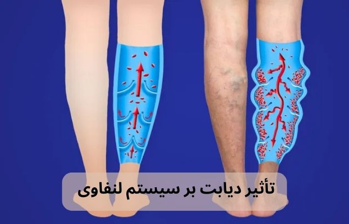 تاثیر دیابت بر سیستم لنفاوی