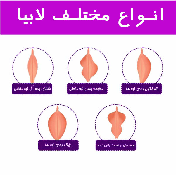 انواع مختلف لابیاپلاستی