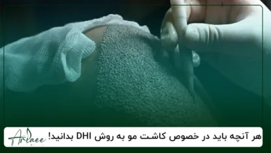 کاشت مو به روش DHI بدانید