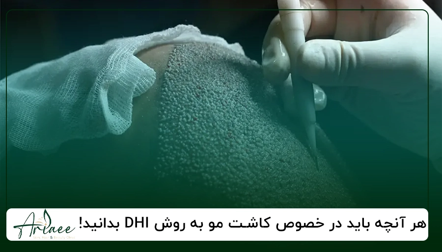کاشت مو به روش DHI بدانید