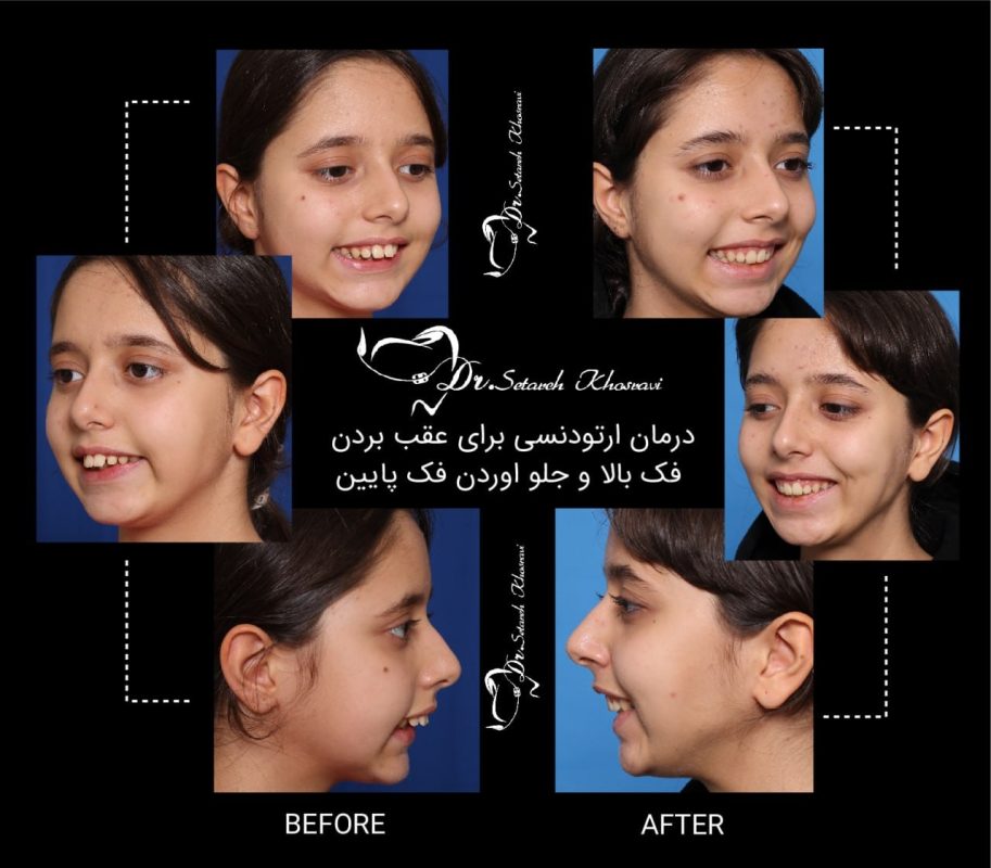 درمان ارتودنسی براب عقب بردن فک بالا