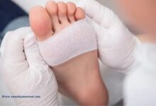 درمان زخم مزمن