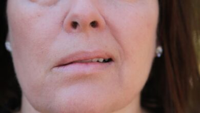 فلج بلز کهنه در صورت خانم