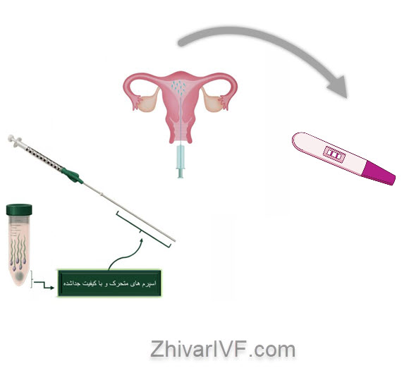 درمان ناباروری با روش IUI