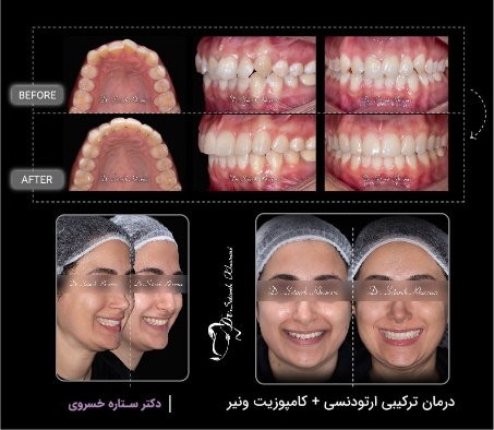 درمان ترکیبی ارتودنسی +کامپوزیت ونیر