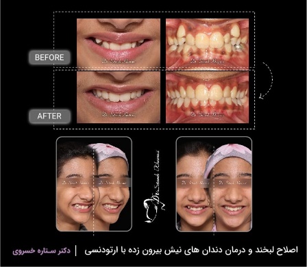 هزینه ارتودنسی در تهران