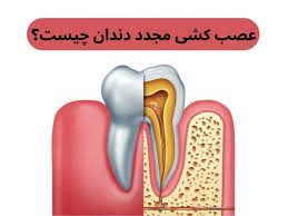 عصب کشی مجدد دندان با لیزر