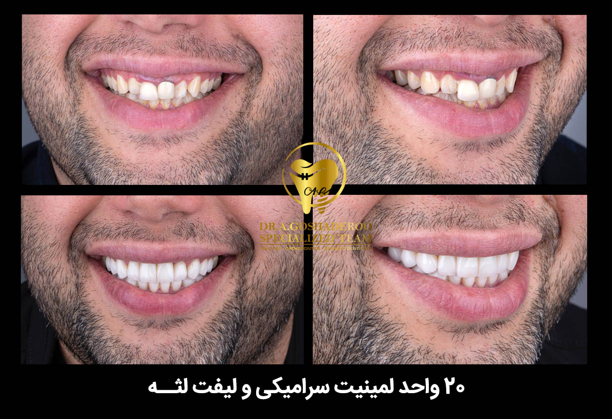 لیفت لثه و لمینت سرامیکی