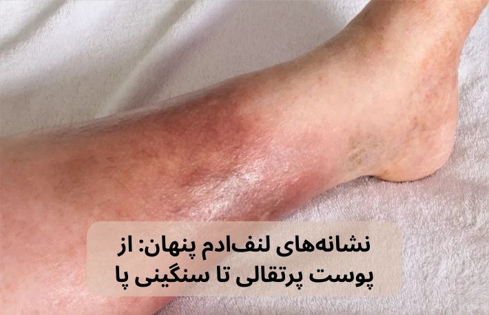 نشانه های لنف ادم پنهان در افراد دیابتی