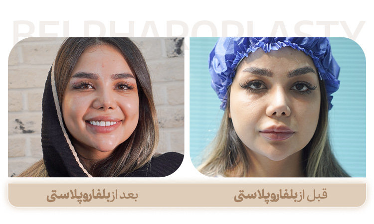 نمونه کار بلفاروپلاستی در مشهد