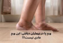 ورم پا در بیمار دیابتی
