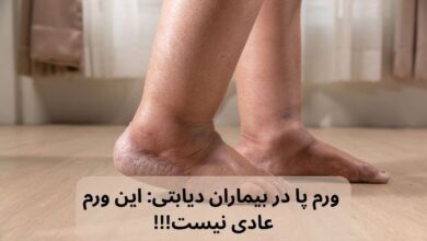 ورم پا در بیمار دیابتی