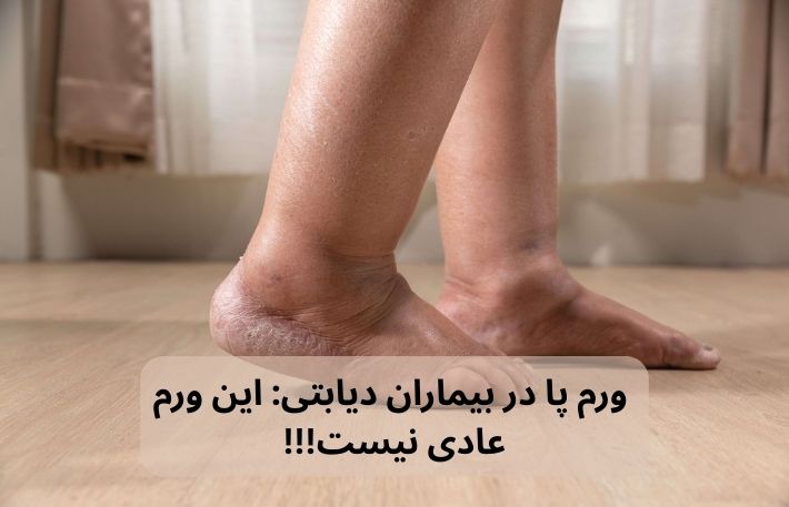 ورم پا در بیمار دیابتی