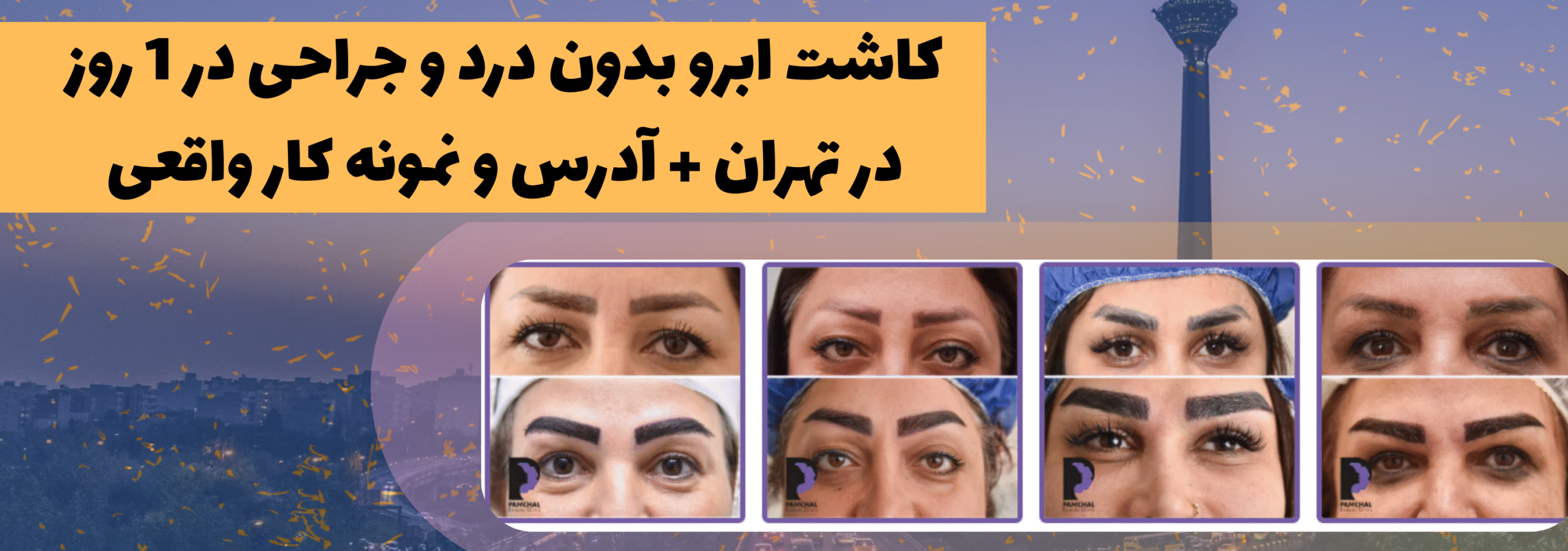 جدیدترین روش کاشت ابرو در ایران - میکروکاشت ابرو (کاشت ابرو به روش میکروگرافت و نانو کاشت ابرو) (micrograft-nanograft)
